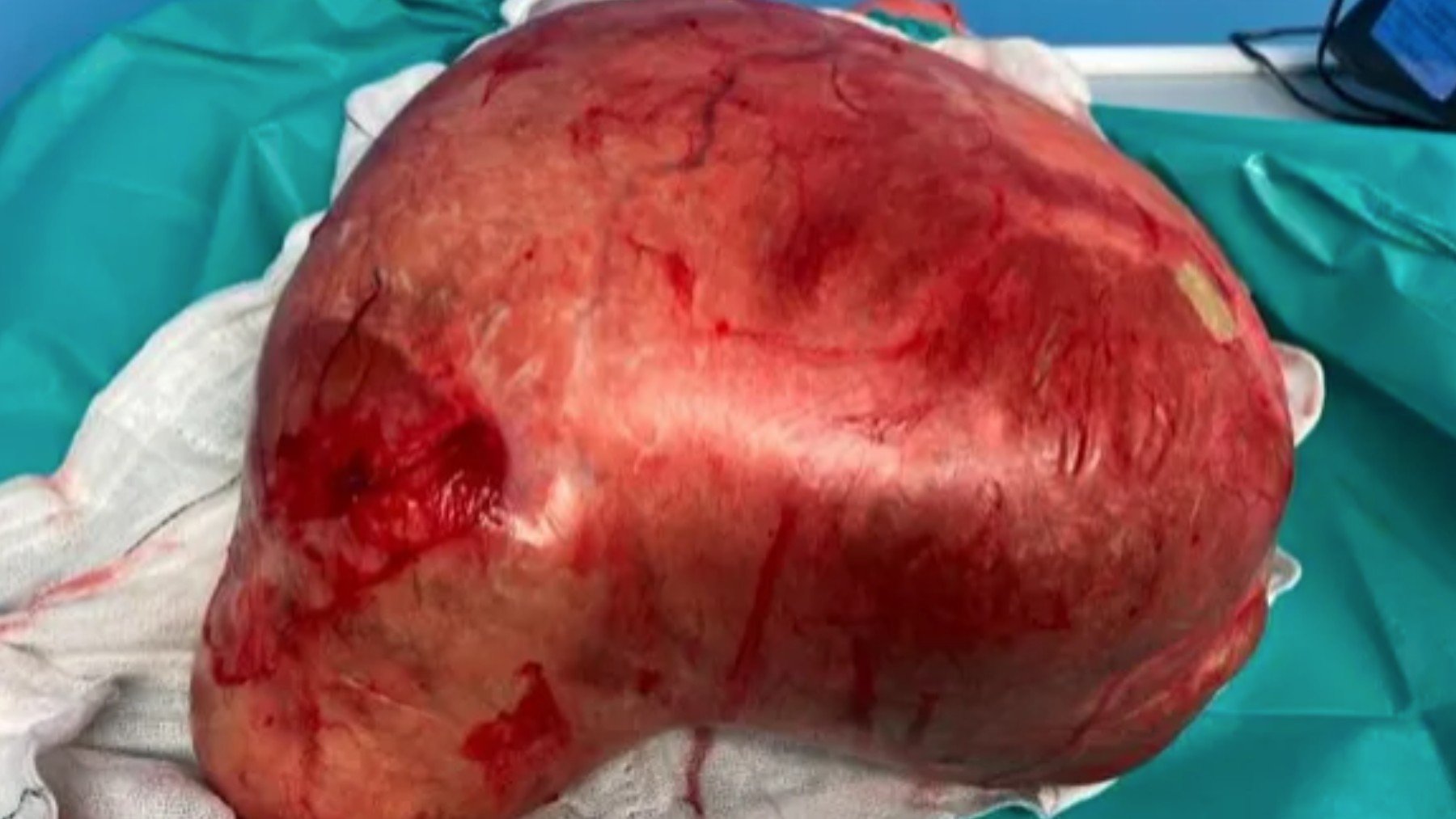 Imagen del tumor extirpado a una mujer de 63 años.