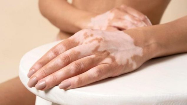 Esto es lo que han descubierto los científicos sobre el vitiligio y el desarrollo del cáncer