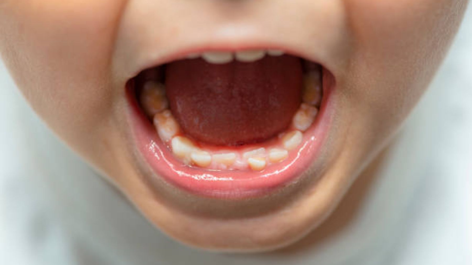 En qué consiste la fluorosis dental y cómo tratar