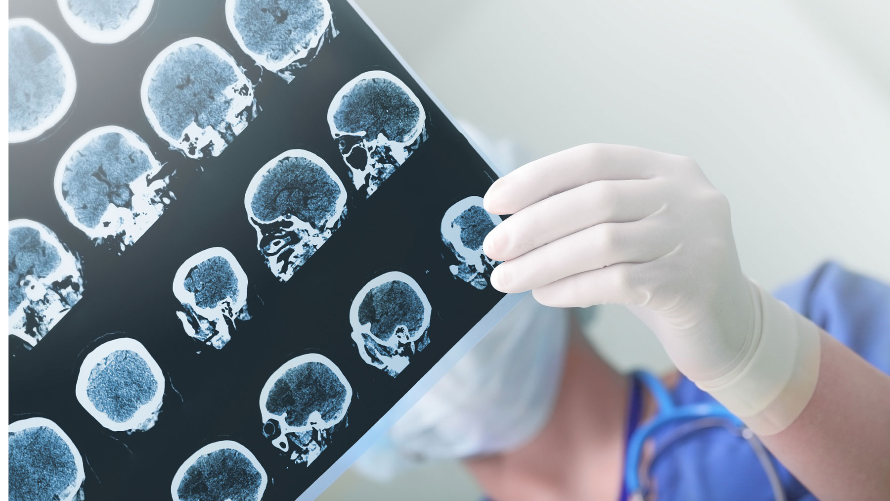 La presencia de tumores cerebrales se realiza a partir de material genético de desecho en el líquido cefalorraquídeo.