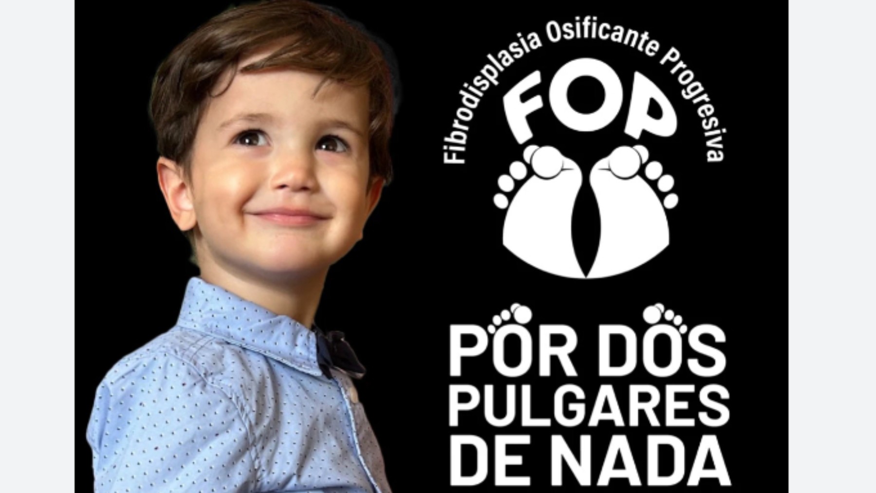 Darío, el niño de 2 años que lucha contra la ultra rara fibrodisplasia osificante.