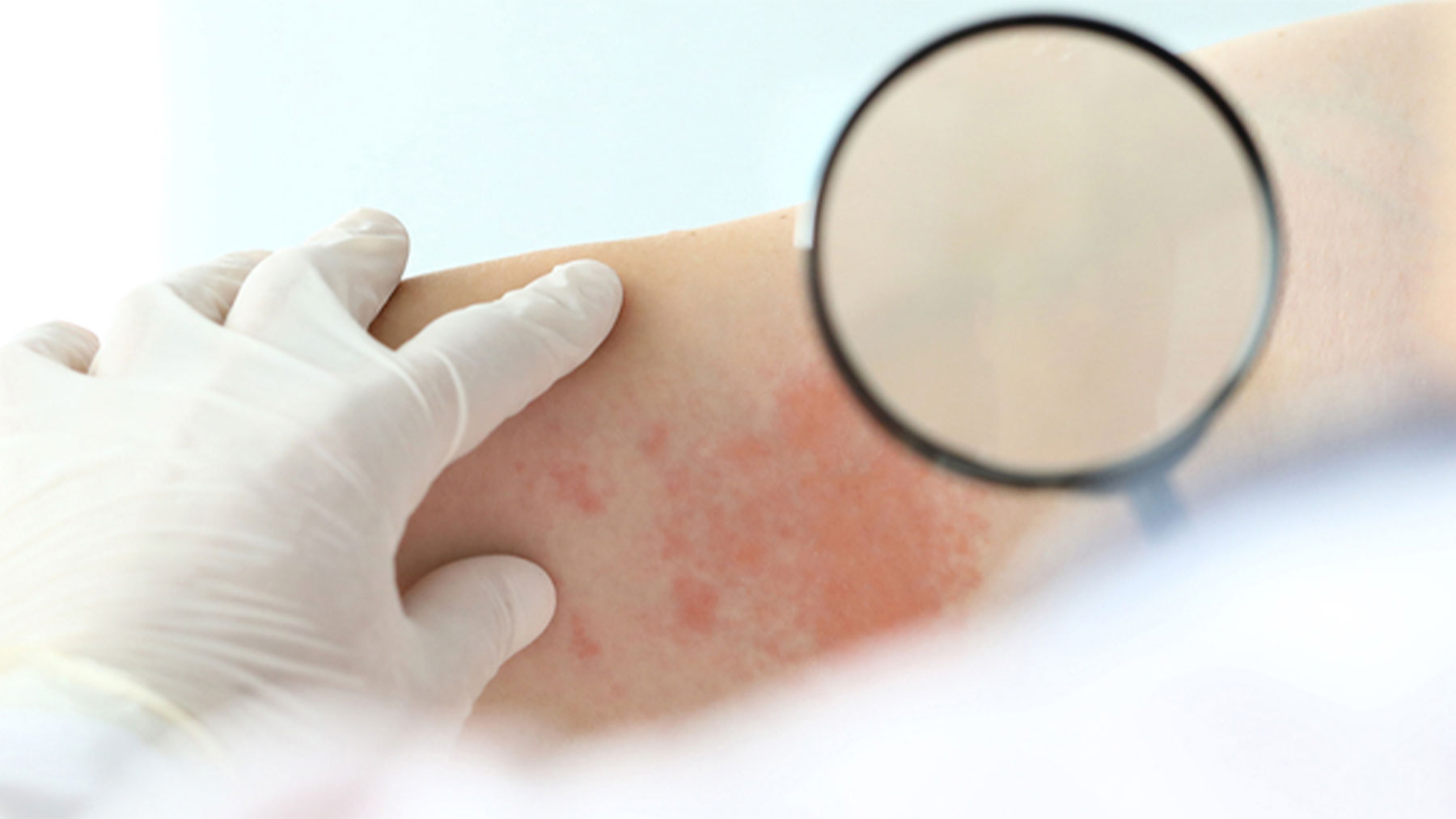 El inicio de la enfermedad cursa presentándose con lesiones cutáneas de color rojo-violáceo en la piel.