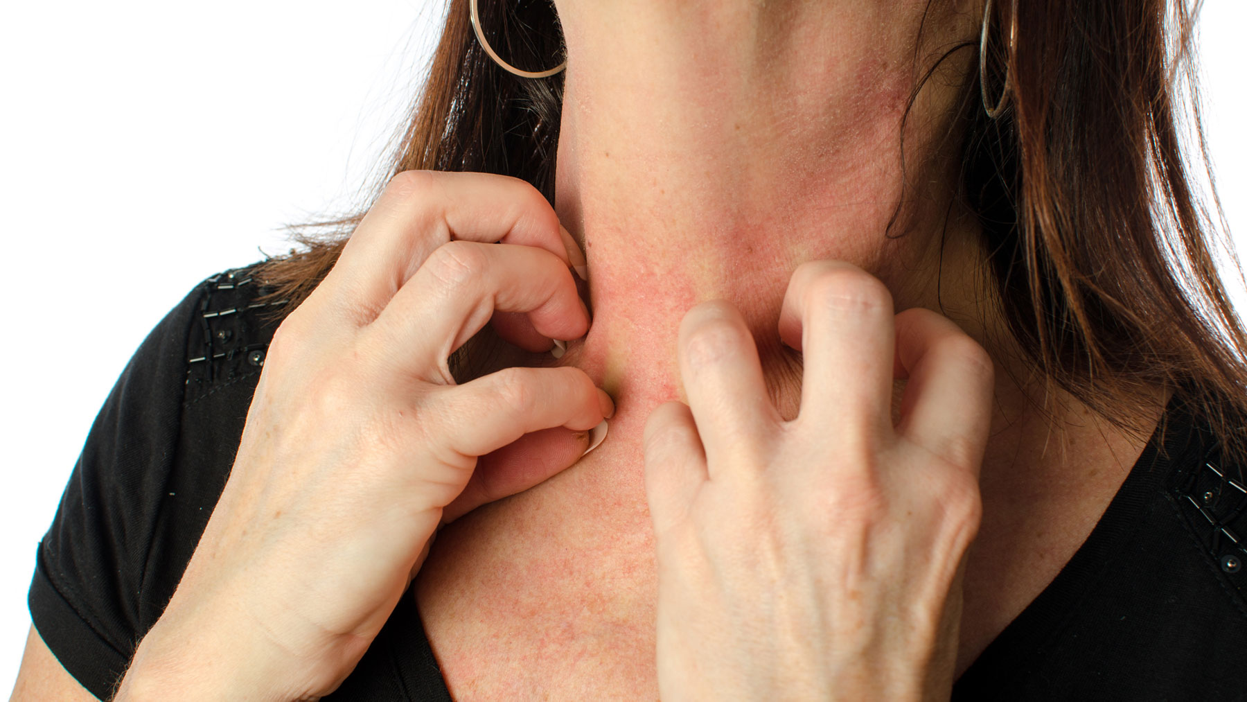 La aparición de la dermatitis atópica conlleva generalmente una predisposición genética.