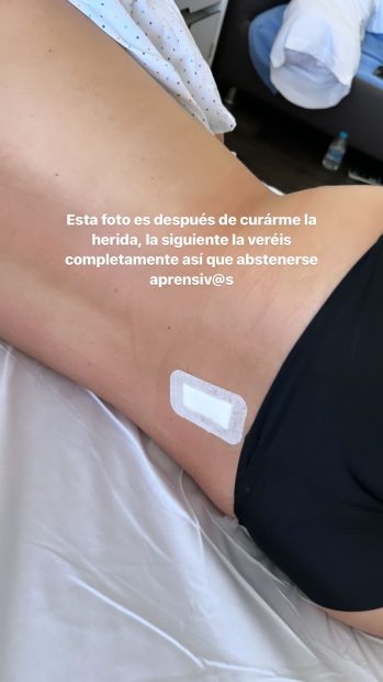Nagore Robles muestra las heridas de su operación de espalda (Instragram)