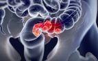 El cribado precoz, la herramienta que reduce hasta un 43% el riesgo de morir por cáncer colorrectal