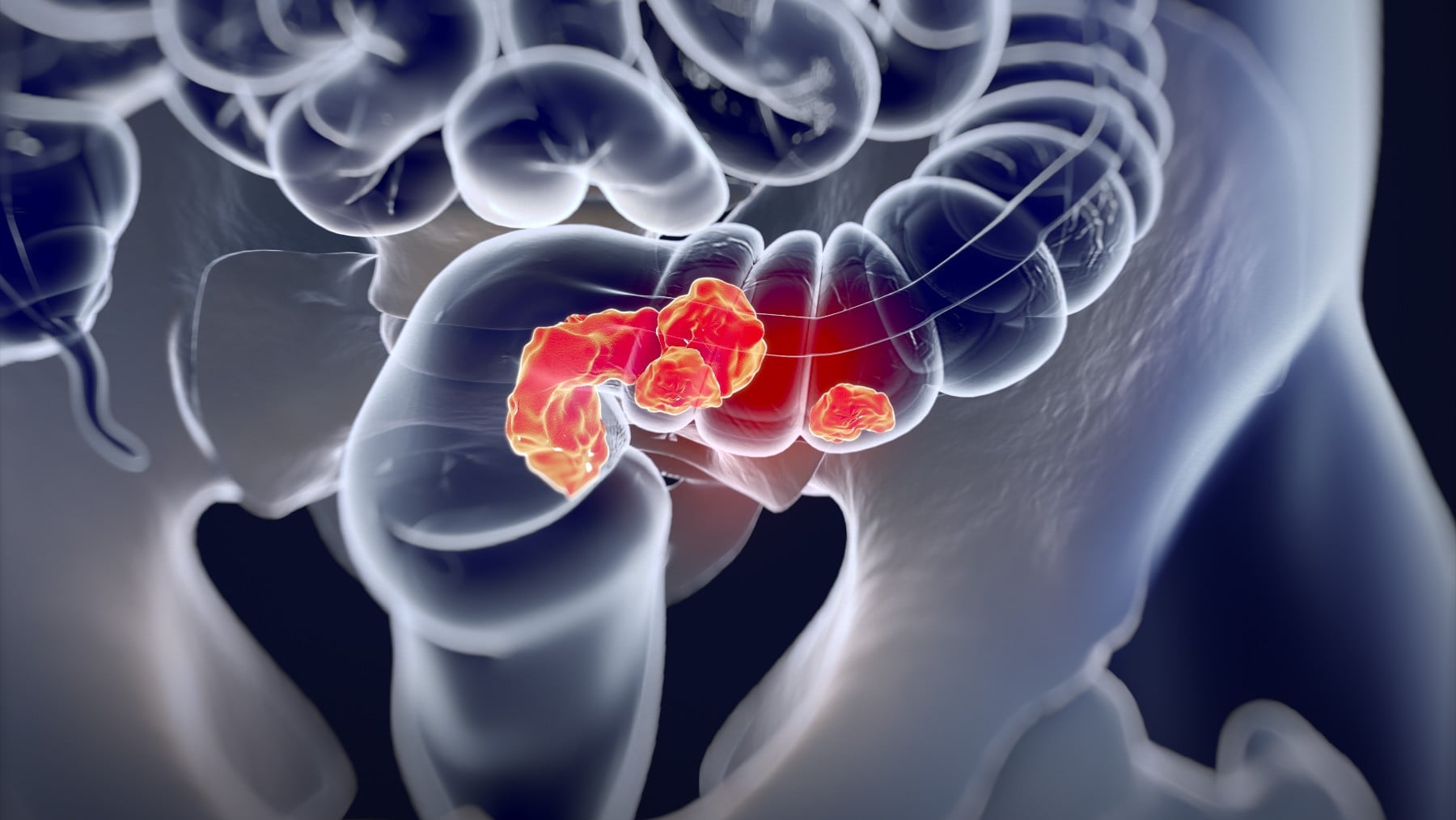 El cribado precoz, la herramienta que reduce hasta un 43% el riesgo de morir por cáncer colorrectal