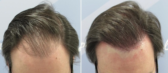 Novedad en trasplante capilar: entrar al quirófano con alopecia y salir con el pelo largo