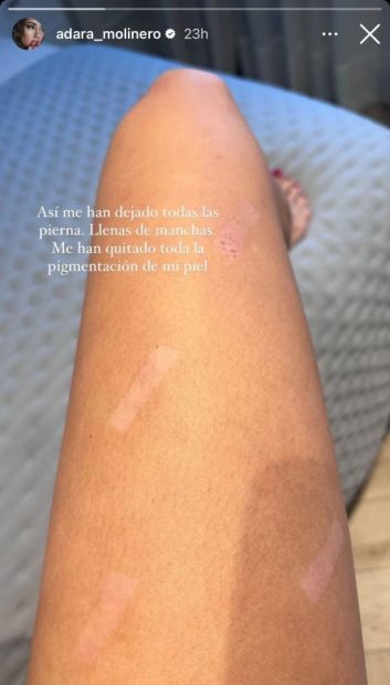 Adara Molinero updates her health status after several weeks of suffering burns (Instagram).
