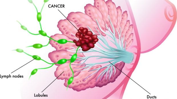 c&aacute;ncer de mama