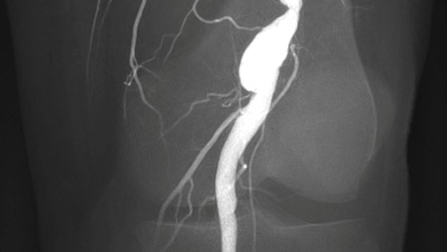 aneurisma de rodilla