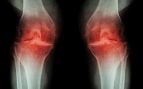 artrosis de rodilla