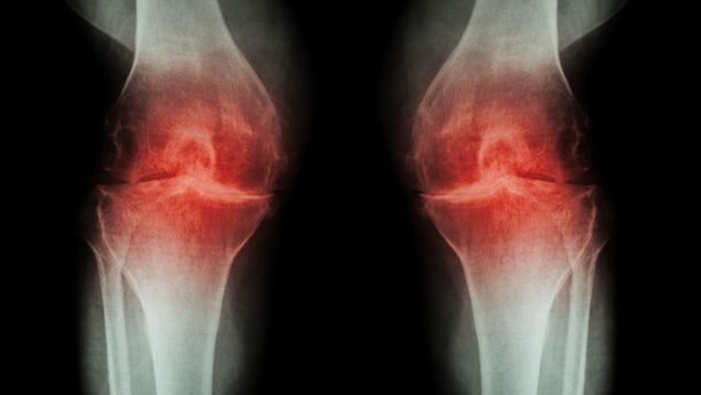artrosis de rodilla