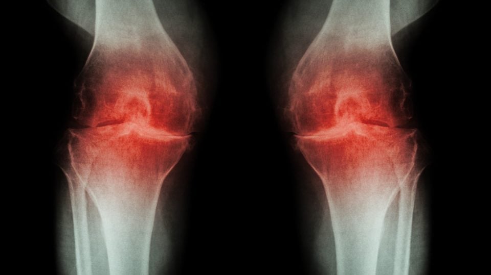 El lado oscuro de las radiografías de rodilla: más perjuicio que beneficio