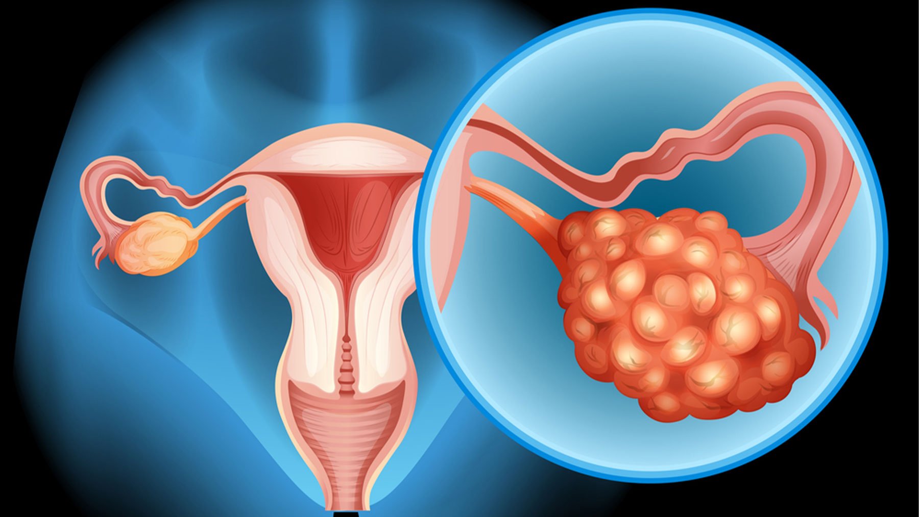 En 2023 se detectaron 3.600 nuevos casos de cáncer de ovario.