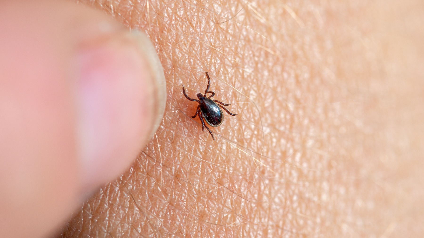 Imagen de una garrapata marrón en la piel humana. (Foto: EP)