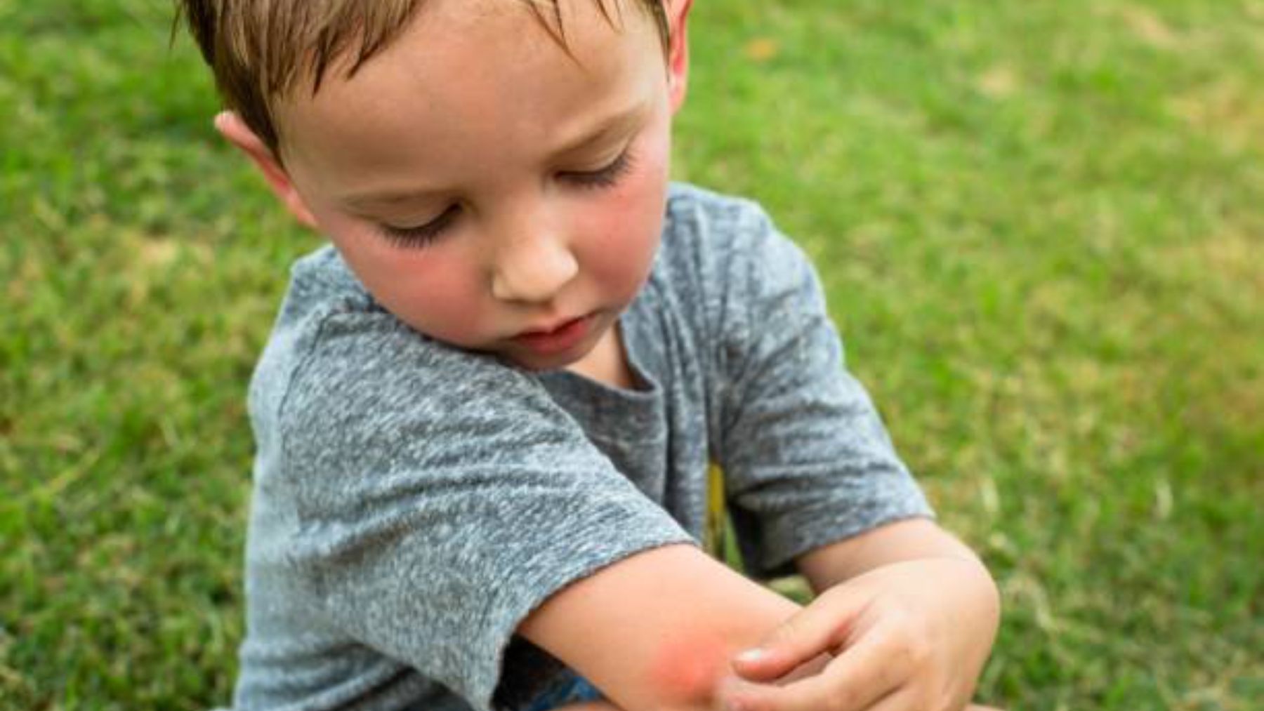 Niño con picada de mosquito.