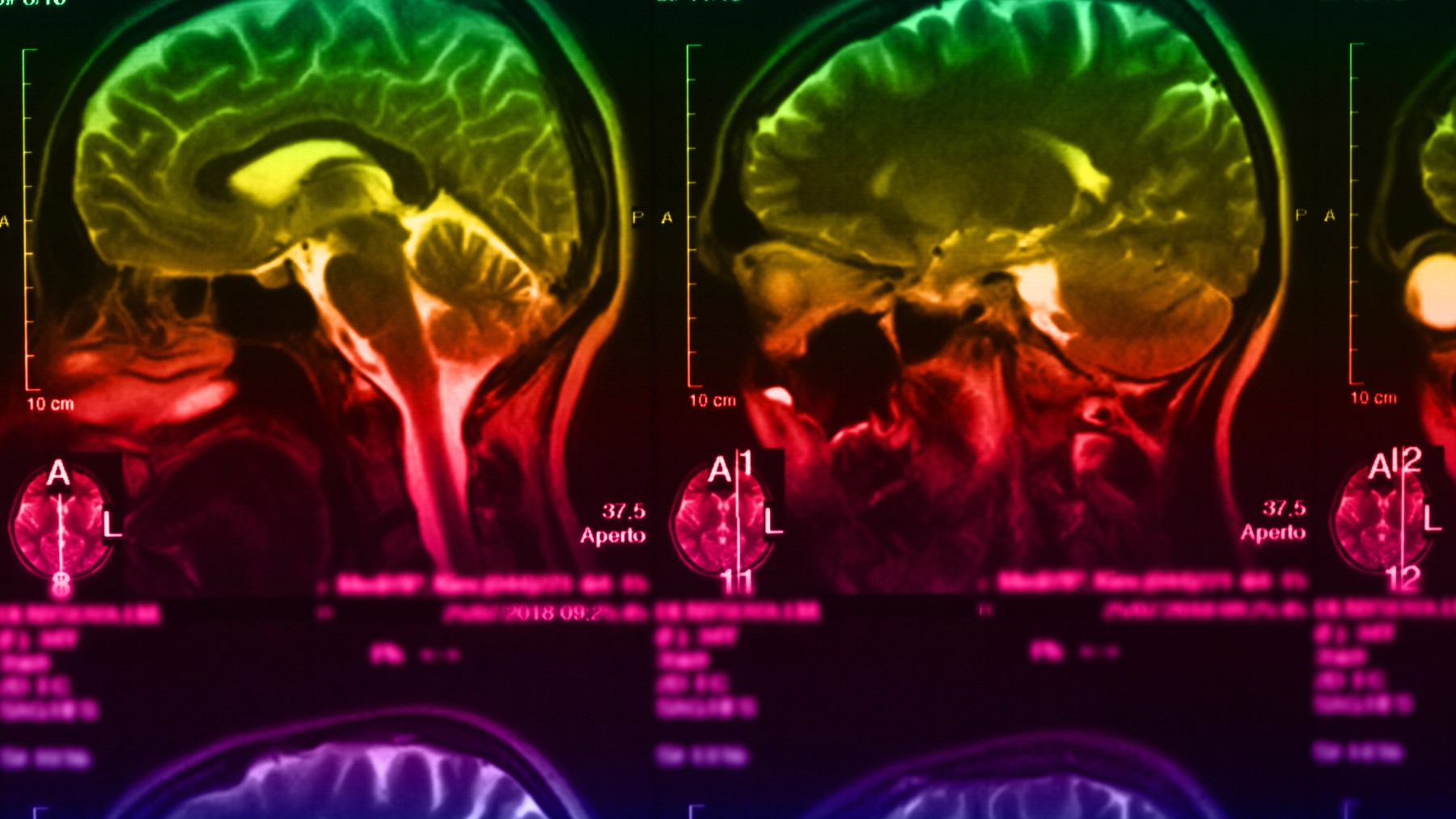 Imagen de un cerebro donde se pueden ver las placas de almiloide que el nuevo fármaco destruye.