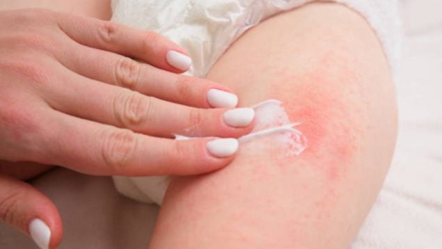 Foto de la mano de una mujer que aplica crema en la pierna de un bebé con dermatitis.