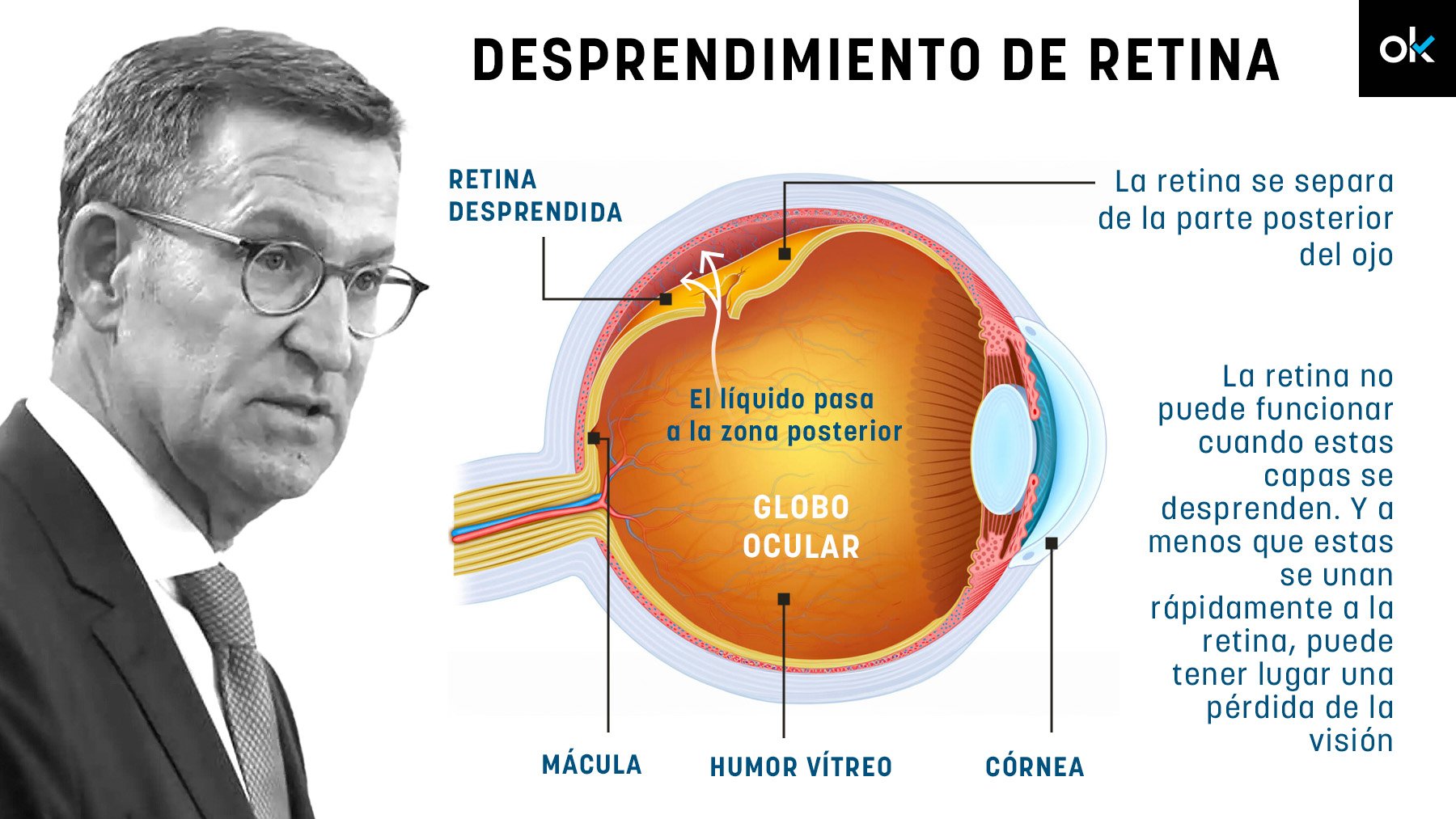 Ésta es la cirugía a la que se ha sometido Feijóo para reparar su desprendimiento de retina.