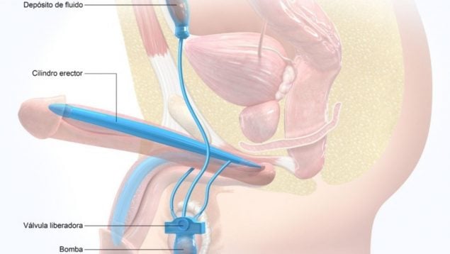 disfunción eréctil