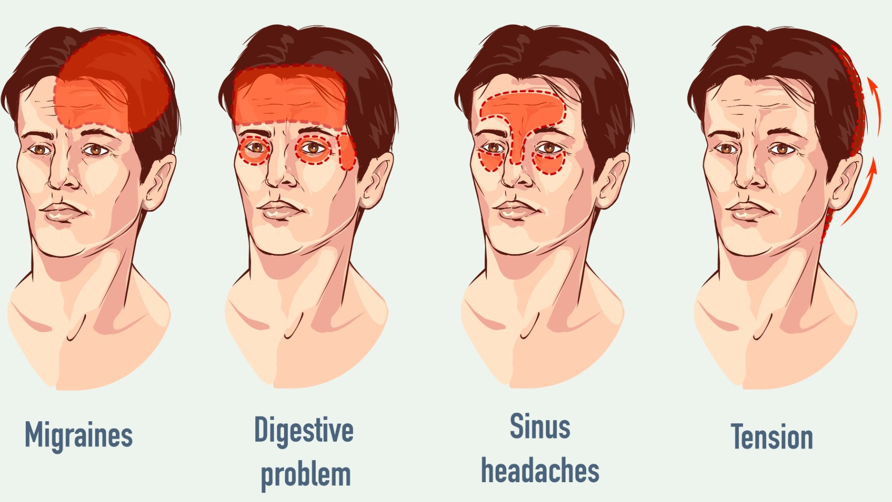 Ilustración de casos de migraña.