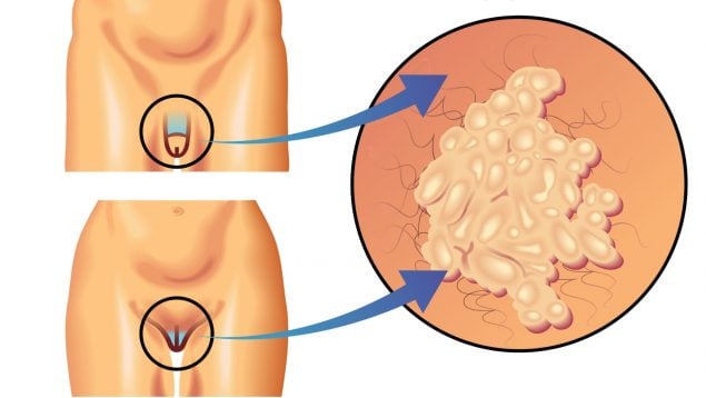 verrugas genitales