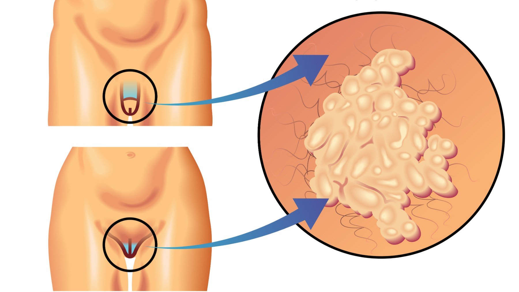 Verrugas genitales en hombres y mujeres.