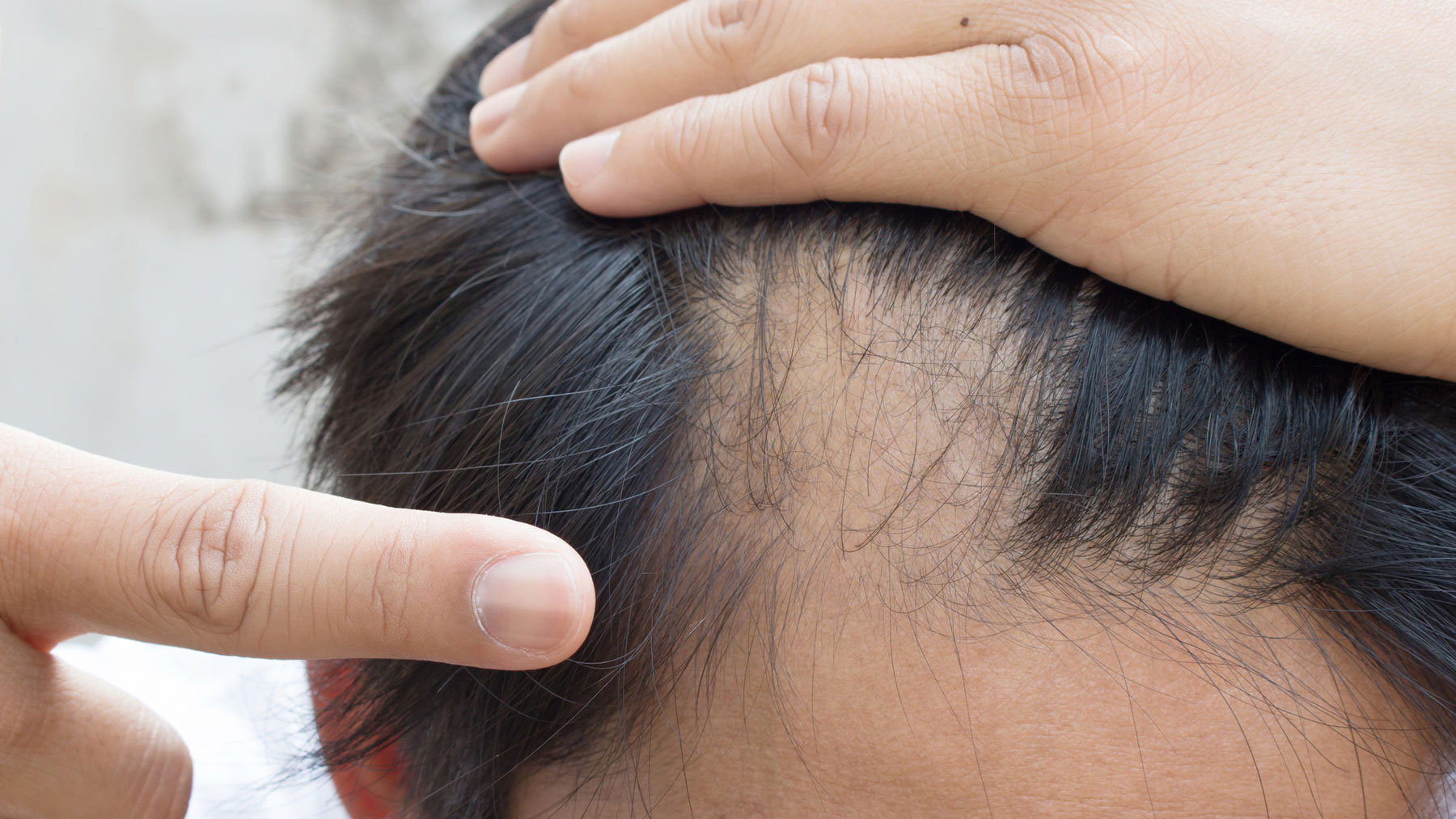 La alopecia androgenética es mucho más frecuente en varones. 