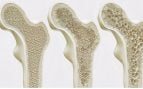 osteoporosis