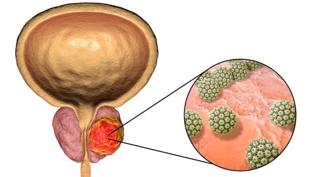 cáncer de testículos