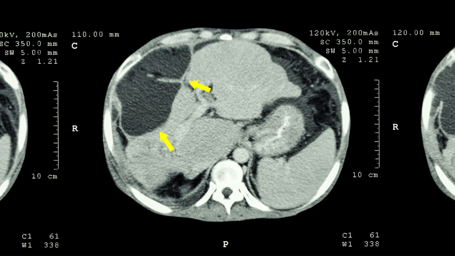 A therapeutic alternative for inoperable tumors such as the pancreas or liver.