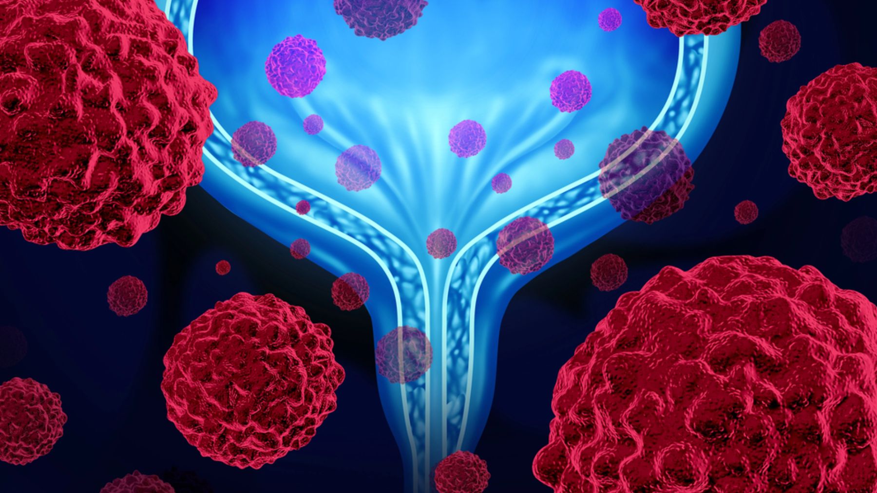 El cáncer de vejiga es el cuarto tumor más frecuente entre los varones.