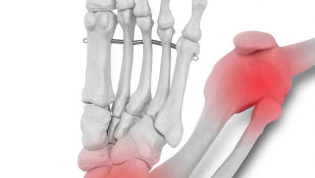 osteosarcoma