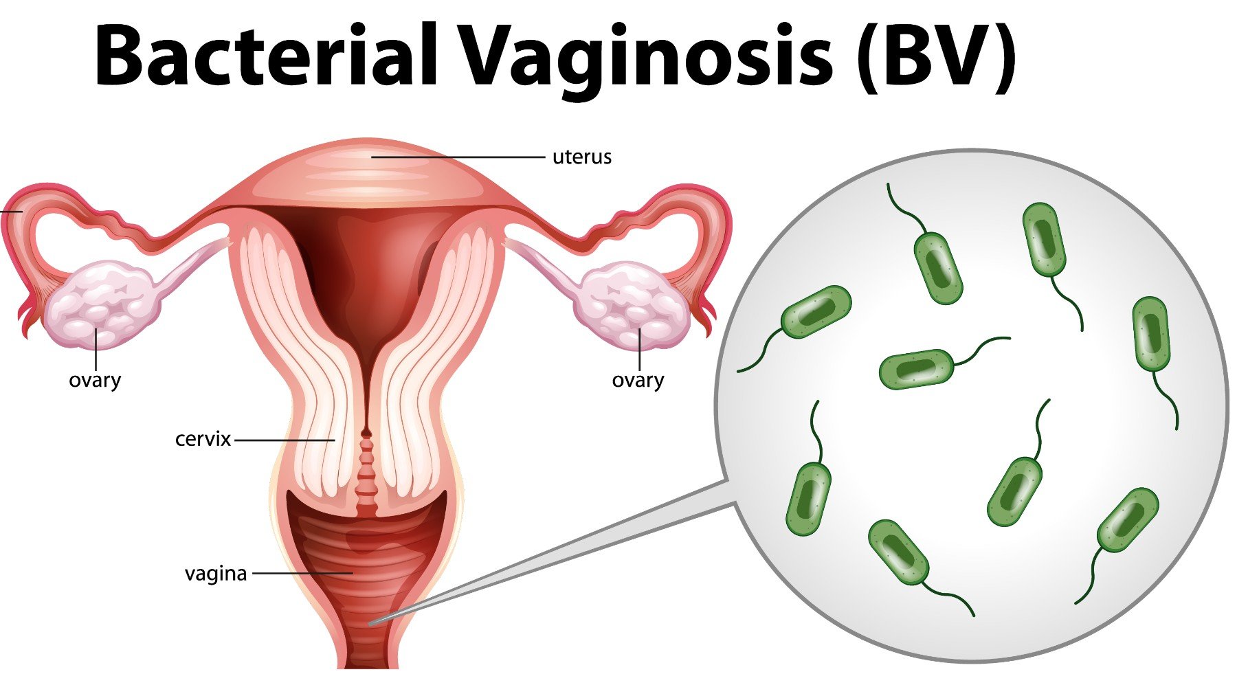 Un vector de vaginosis bacteriana.