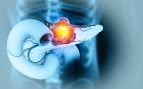cáncer de páncreas