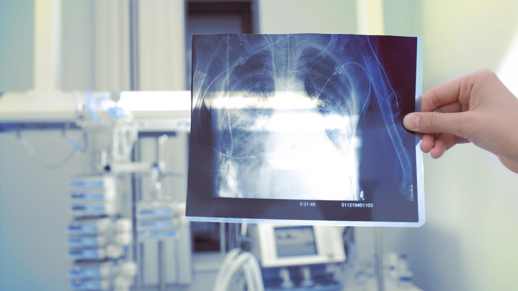 Una radiografía donde se ve un caso de EPC pulmonar.