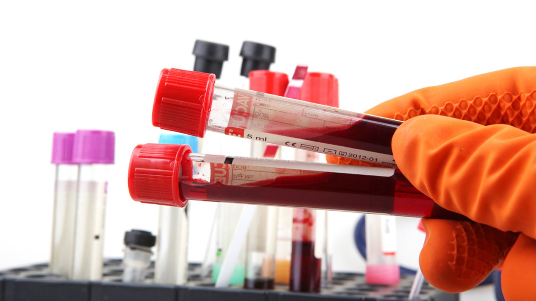 Anemia de Fanconi: una enfermedad genética y hereditaria que se detecta en la infancia