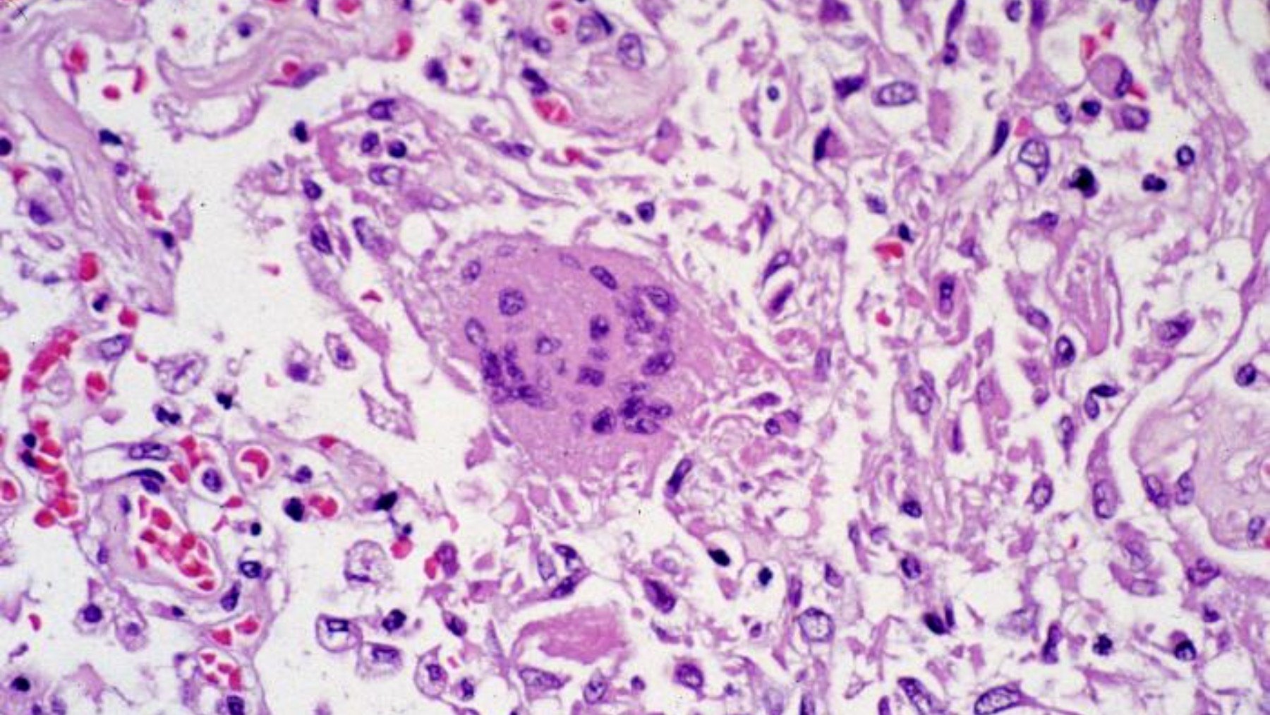 Alerta máxima: Brasil decreta emergencia sanitaria ante el aumento de casos de un virus