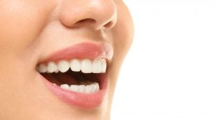 Quitar el sarro de los dientes