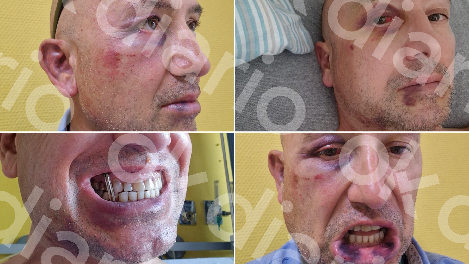 La víctima, Vicent, ha perdido el 50% de audición y tiene 5 tornillos en la mandíbula.OKDIARIO.