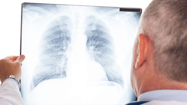 cáncer de pulmón