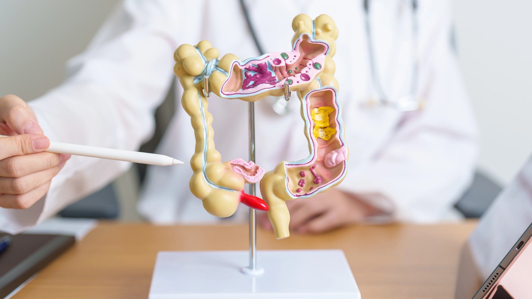 Un doctor muestra un colon y el apéndice.