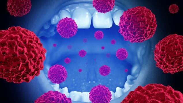 cáncer oral
