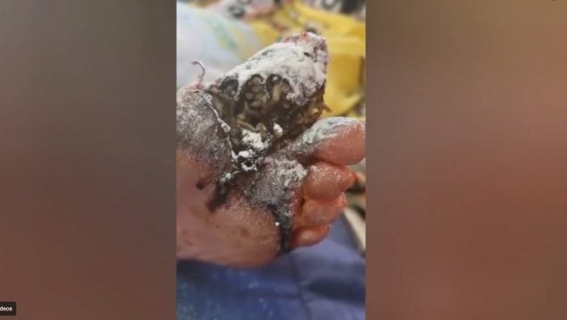 Una marroquí con gangrena y gusanos en los pies acaba en el hospital de Algeciras por abandono extremo