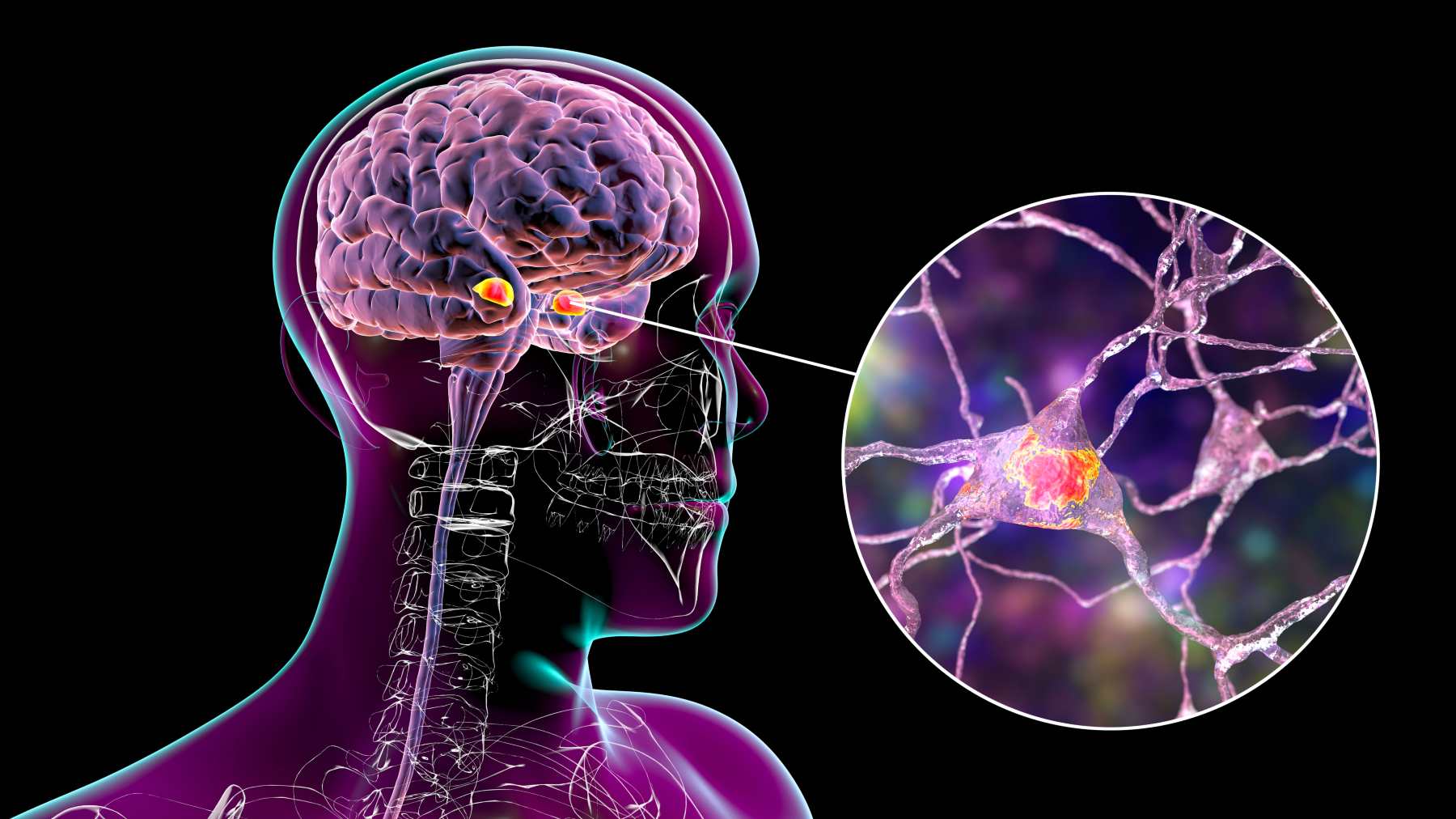 Estimulación cerebral profunda.