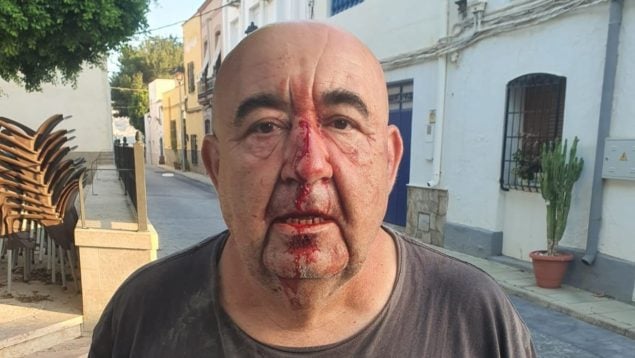 El concejal de Medio Ambiente de Alsodux (Almería), José Manuel Gil, tras ser agredido con una piedra en la cara.