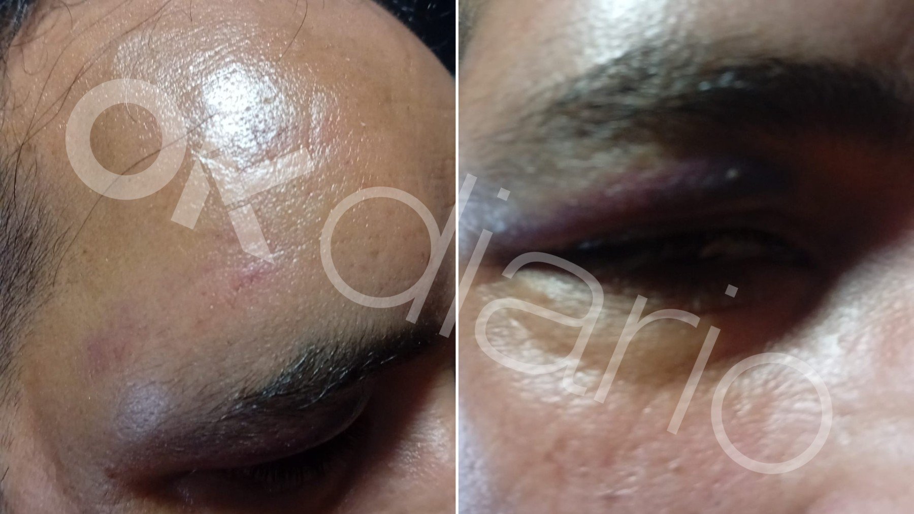 Yassine, el vecino detenido por enfrentarse al ladrón que intentó asaltar su casa, herido por la pelea. OKDIARIO.