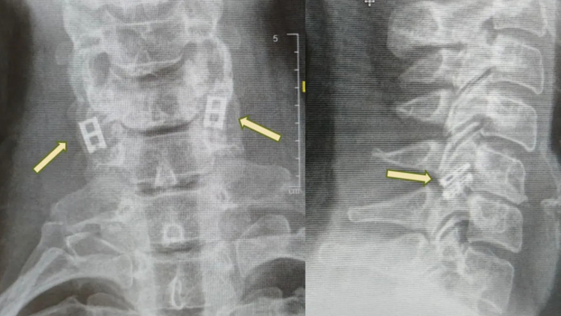 Zonas de la columna vertebral que serán reemplazadas.