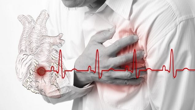 Corazón infarto