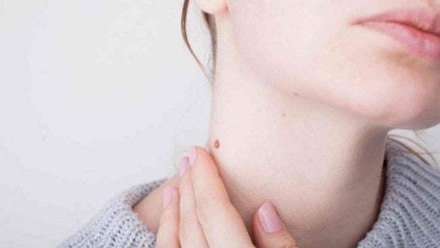 Por qué te salen verrugas en el cuello y cómo quitarlas fácilmente